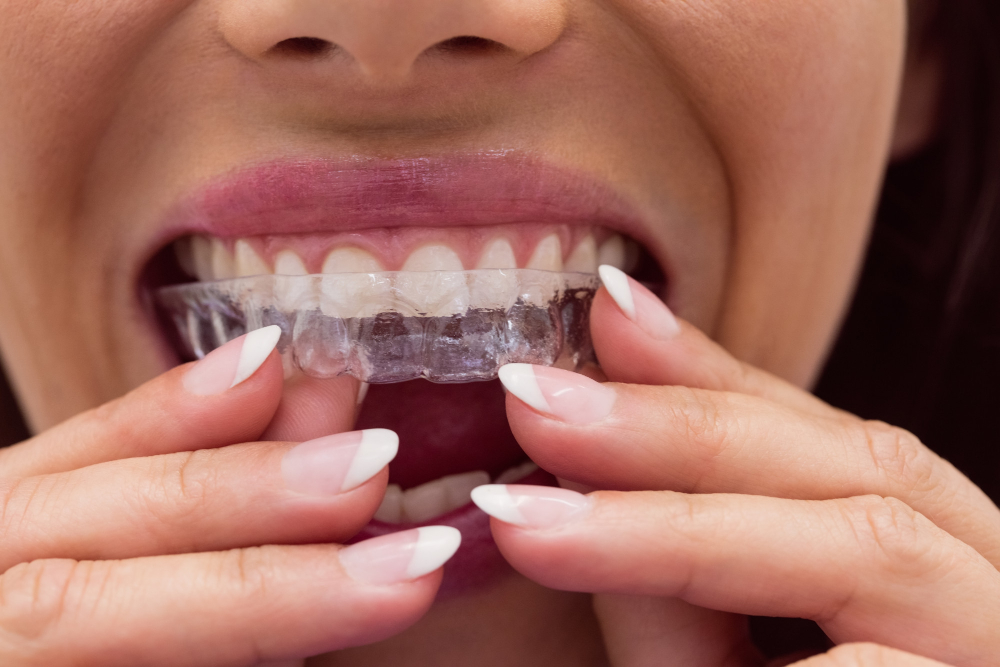 İnvisalign Şeffaf Plak Ne İşe Yarar İnvisalign Şeffaf Plak